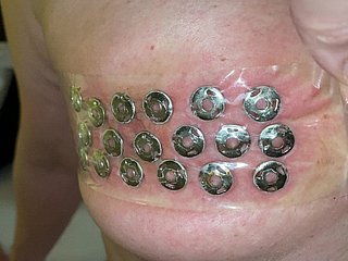 چھاتی سے thumbtacks کی برطرفی