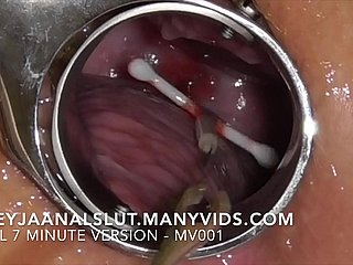 아마추어 Freyjaanalslut : 그녀의 IUD 제거 - Freyja의 자궁 경부에서 꺼내서 그녀의 비옥 한 것으로 다시 만들어졌습니다 - MassVids의 전체 버전